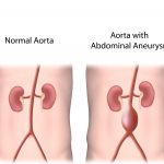 Abdominal Aortic Aneurysms: Be Aware of Risk Factors for This Asymptomatic, Potentially Life-Threatening Condition