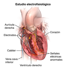 TestUbicación de los electrodos en el corazón durante un estudio electrofisiológico.