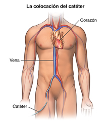 TestEl cuerpo de un hombre con un catéter insertado en la pierna y llega hasta una arteria del corazón. 